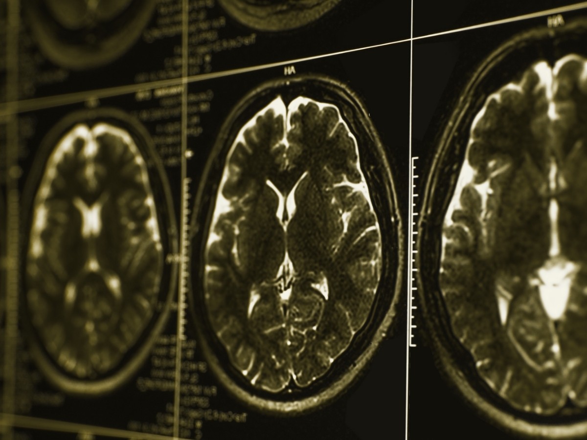 MRI showing potential brain injury